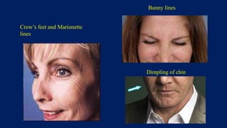 Crow’s feet and Marionette
lines
Bunny lines
Dimpling of chin
 