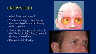 CROW'S FEET
• orbicularis oculi muscle.
• The treatment goal is reducing
dynamic rhytides and softening
static rhytides.
• Site - Injection given in each of
the 3 blue circles (photo) on each
side and the red X’s.
• Dosage – 5-15 U/side
 