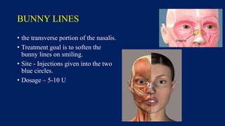 BUNNY LINES
• the transverse portion of the nasalis.
• Treatment goal is to soften the
bunny lines on smiling.
• Site - Injections given into the two
blue circles.
• Dosage – 5-10 U
 