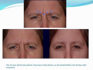 The 52-year-old female patient, frowning in both photos, as she looked before and 32 days after
treatment

 