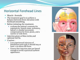 Horizontal Forehead Lines
 Muscle : frontalis
 The treatment goal is to achieve a
balance between brow elevation with

forehead smoothing.
 Before initiating the treatment,

 evaluate the patient's anatomy for

expressivity, muscle mass, symmetry,
lateral v/s medial movement,
compensation for brow ptosis, and a
narrow or wide brow.

 injection given at blue circles and
optional red Xs.
 Caution :
 Less experienced injectors of
botulinum toxin type A should stay at
least 2 cm above the brow.
 Ensure that injection sites are lateral
enough to avoid a quizzical eyebrow
appearance.

 