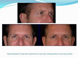 Patient depicted 17 days after treatment for crow's feet. Smiling without crow's feet wrinkles.

 
