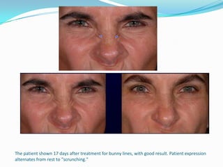 The patient shown 17 days after treatment for bunny lines, with good result. Patient expression
alternates from rest to "scrunching."

 