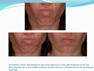 The patient is shown alternating from rest to full expression 17 days after treatment of the chin.
After treatment she is seen unable to flex her mentalis and cause a dimpled chin as she could before
treatment.

 