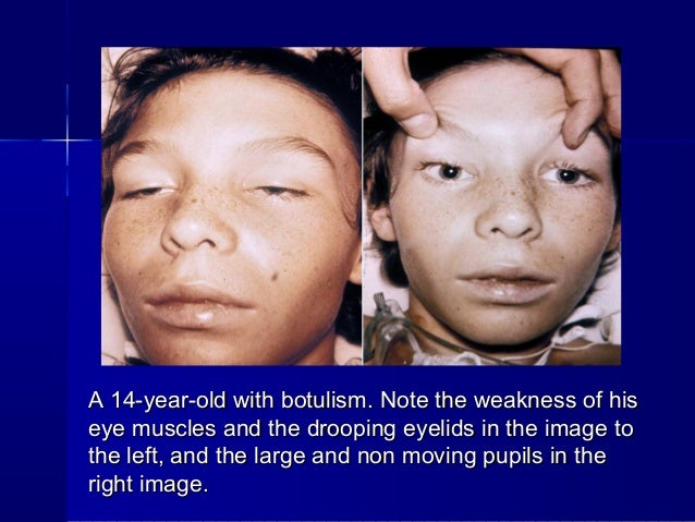 botulism