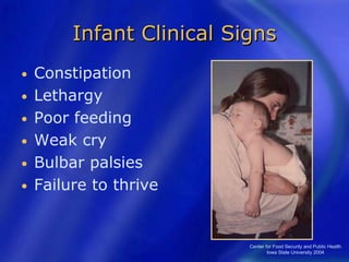 Center for Food Security and Public Health
Iowa State University 2004
Infant Clinical Signs
• Constipation
• Lethargy
• Poor feeding
• Weak cry
• Bulbar palsies
• Failure to thrive
 