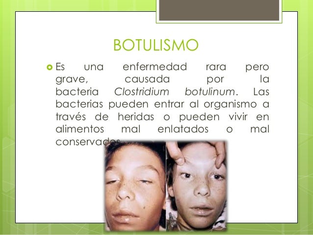 Botulismo