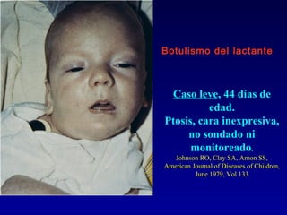 Botulismo del lactante



 Caso leve, 44 días de
          edad.
Ptosis, cara inexpresiva,
     no sondado ni
      monitoreado.
   Johnson RO, Clay SA, Arnon SS,
American Journal of Diseases of Children,
          June 1979, Vol 133
 