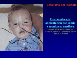 Botulismo del lactante




    Caso moderado,
alimentación por sonda
 y monitoreo cardíaco.
   Johnson RO, Clay SA, Arnon SS,
American Journal of Diseases of Children,
          June 1979, Vol 133
 