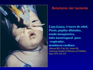 Botulismo del lactante




Caso Grave, 4 meses de edad.
Ptosis, pupilas dilatadas,
sonda nasogástrica,
tubo nasotraqueal para
 respirador,
monitoreo cardíaco
Johnson RO, Clay SA, Arnon SS,
American Journal of Diseases of Children,
June 1979, Vol 133
 
