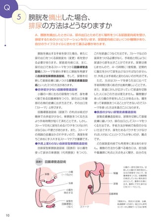 10
5
Q
図表7
これを尿道につなぐ方法です。ストーマなどの
装具をつける必要がなく、手術前と同じように
尿道から尿を出すことができます。尿意は感
じませんので、４～５時間に1度程度、定期的
に腹圧をかけて尿を出さなければなりません
が、外見上は手術前と変わらないのが利点です。
　ただ、欠点はストーマを使う方法に比べて
手術時間が長く術式が比較的難しいことです。
また、尿道にがんが広がっていて尿道を切除
した人にはこの方法は使えません。腸閉塞が
あったり腸の手術をしたことがある人も、腸を
使って新膀胱をつくることができないのでスト
ーマを使った方法を選ぶことになります。
●負担の少ない尿管皮膚瘻造設術
　尿管皮膚瘻造設術は、尿管を切断して直接
皮膚に尿管を縫いつけ、尿の出口としてスト
ーマをつくる方法です。手術方法が単純で負
担の少ない方法ですが、尿をためるパウチを
つけなければいけないことと、ストーマ合併症
などのトラブルが多いのが難点です。
　どの尿路変向術でも再発率に差はありませ
ん。複数の方法から選べる場合には、担当医
や看護師に利点と欠点をよく聞き、自分の生
　膀胱を摘出する手術を受けた場合、新たに
尿の出口をつくる尿路変向（変更）術を受け
る必要があります。尿路変向術には、主に、
尿の出口であるストーマをつける回腸導管造
設術、ストーマを使わず新たに膀胱を再建す
る自排尿型新膀胱造設術、そして、尿管を切
断して直接皮膚に縫いつける尿管皮膚瘻造設
術という3つの方法があります。
●合併症が少ない回腸導管造設術
　小腸の一部を切除して左右の尿管をつなぎ、
尿を導く回腸導管をつくり、尿の出口を腹部
の右側の皮膚に出す方法です。その出口を「ス
トーマ」と呼びます。
　回腸導管造設術（図表７）の利点は術式が
簡単で合併症が少なく、新膀胱をつくる方法
より手術時間が短くて済むことです。しかし、
ストーマの先に尿をためるパウチをつけなけれ
ばならない不便さがあります。また、ストーマ
の周囲の皮膚はかぶれやすいので、清潔を保
ちこまめに手入れするストーマケアが重要です。
●外見上変わらない自排尿型新膀胱造設術
　自排尿型新膀胱造設術（図表８）は小腸を
使って袋状の新膀胱（代用膀胱）をつくり、
回腸導管造設術
A．膀胱を摘出したときには、尿の出口とためておく場所をつくる尿路変向術を受け、
排尿するためのリハビリテーションを行います。尿路変向術にはいくつか種類があり、
自分のライフスタイルに合わせて選ぶ必要があります。
膀胱を摘出した場合、
排尿の方法はどうなりますか
小腸の一部を切除する。切
除した小腸の片側を吻合し、
左右の尿管をつないで、回
腸導管をつくる。回腸導管
の吻合していない側を尿の
出口として、腹部の右側に
出す。腹部にできた尿の出
口をストーマという。
「膀胱がん　受診から診断、
治療、経過観察への流れ」
国立がん研究センターがん情
報サービスなどを参考に作成
腎臓
小腸
（～15cm）盲腸
虫垂
尿管
回腸導管
ストーマ
尿管を回腸導管
につなぐ
小腸を
吻合する
尿管
 