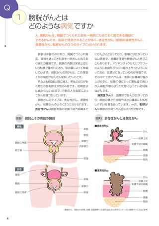 4
にがんがとどまっており、筋層には広がってい
ない状態で、筋層非浸潤性膀胱がんと呼ぶこ
ともあります（図表2）。イソギンチャクかカリ
フラワーのように表面がぶつぶつ盛り上がり、
乳頭状になっているのが特徴です。また、上
皮内がんは、表面には腫瘍が盛り上がらずに、
粘膜の壁に沿って悪性度の高いがん細胞が散
らばった状態になっている特殊ながんです。
　浸潤性がんは、筋層までがんが広がってお
り、膀胱の壁の外側やほかの臓器にも転移し
やすい性質を持っています。
　転移がんは膀胱の外側にがんが広がった状
態です。
　膀胱は骨盤の中にあり、腎臓でつくられ腎
盂、尿管を通ってきた尿を一時的にためておく
袋状の臓器です（図表１）。膀胱の内側は尿路
上皮という粘膜で覆われており、尿の量によっ
て伸縮しています。膀胱がんの90％はこの尿
路上皮の細胞ががん化し成長したものです。
　男女とも60歳以降に増え、男性のほうが多
く、男性の患者数は女性の4倍です。初期症
状は痛みのない血尿で、８割の人が血尿によ
ってがんが見つかっています。
　膀胱がんのタイプは、表在性がん、浸潤性
がん、転移がんなどのタイプに分けられます。
表在性がんは膀胱表面の粘膜下結合組織まで
1 膀胱がんとは
どのような病気ですか
Q
A．膀胱がんは、腎臓でつくられた尿を一時的にためておく袋である膀胱に
できるがんです。血尿で発見されることが多く、表在性がん（筋層非浸潤性がん）、
浸潤性がん、転移がんなどのタイプに分けられます。
「膀胱がん　受診から診断、治療、経過観察への流れ」国立がん研究センターがん情報サービスなどを参考に作成
図表1 膀胱とその周囲の臓器
男性
膀胱三角部
図表2 表在性がんと浸潤性がん
前立腺
尿管口
膀胱
尿管
尿道
女性
膀胱
尿管
尿管口
卵巣
尿道
がん
粘膜上皮
粘膜下結合組織
筋層
漿膜
脂肪
がん
粘膜下結合組織
筋層
漿膜
脂肪
粘膜上皮
膀胱三角部
■表在性がん
■浸潤性がん
内尿道口
 