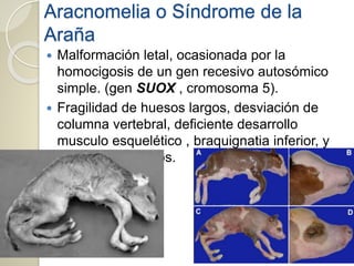 Aracnomelia o Síndrome de la
Araña
 Malformación letal, ocasionada por la
homocigosis de un gen recesivo autosómico
simple. (gen SUOX , cromosoma 5).
 Fragilidad de huesos largos, desviación de
columna vertebral, deficiente desarrollo
musculo esquelético , braquignatia inferior, y
defectos cardiacos.
 