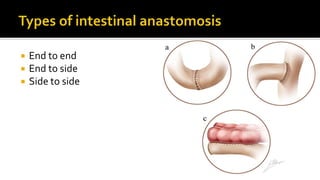  End to end
 End to side
 Side to side
 