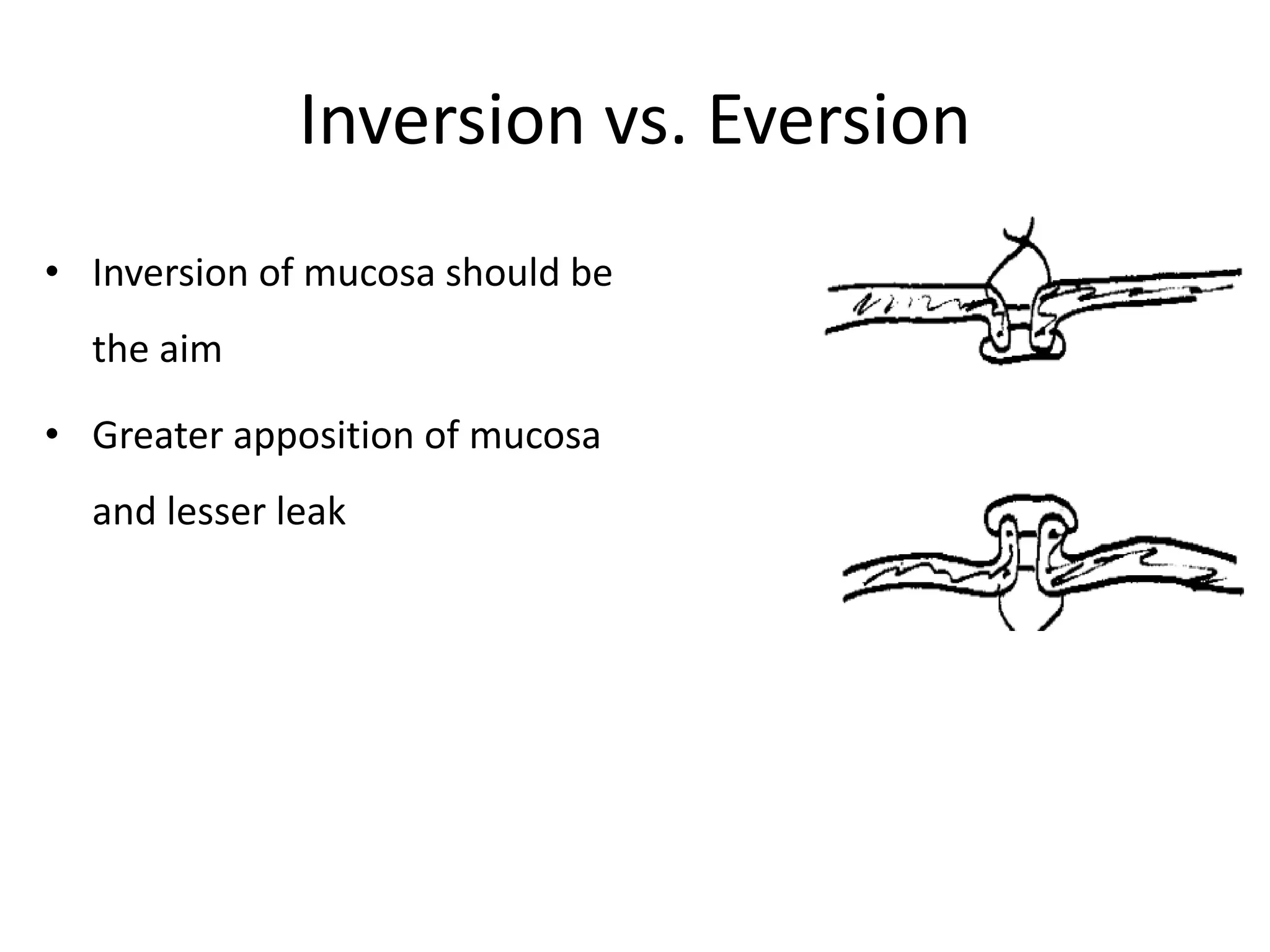 how to perform Safe Bowel anastomosis .pptx