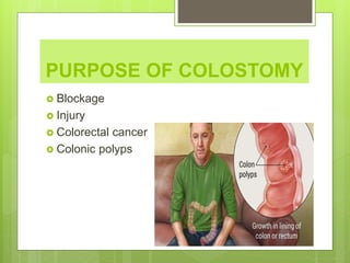 PURPOSE OF COLOSTOMY
 Blockage
 Injury
 Colorectal cancer
 Colonic polyps
 