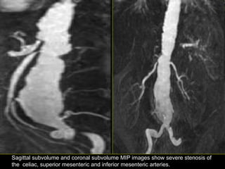 Sagittal subvolume and coronal subvolume MIP images show severe stenosis of
the celiac, superior mesenteric and inferior mesenteric arteries.
 