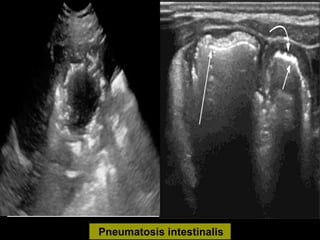 Pneumatosis intestinalis
 
