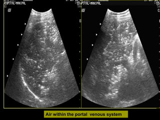 Air within the portal venous system
 