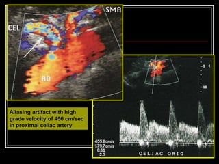 Aliasing artifact with high
grade velocity of 456 cm/sec
in proximal celiac artery
 