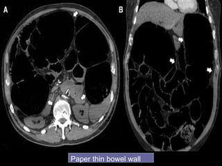 Paper thin bowel wall
 