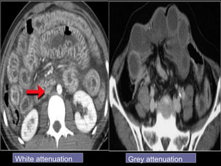 White attenuation Grey attenuation
 