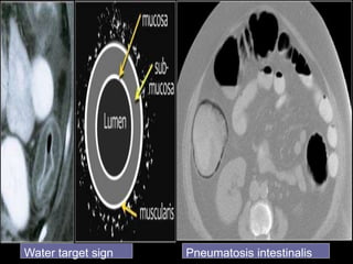 Water target sign Pneumatosis intestinalis
 