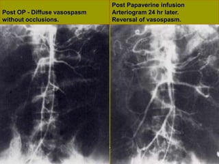 Post OP - Diffuse vasospasm
without occlusions.
Post Papaverine infusion
Arteriogram 24 hr later.
Reversal of vasospasm.
 