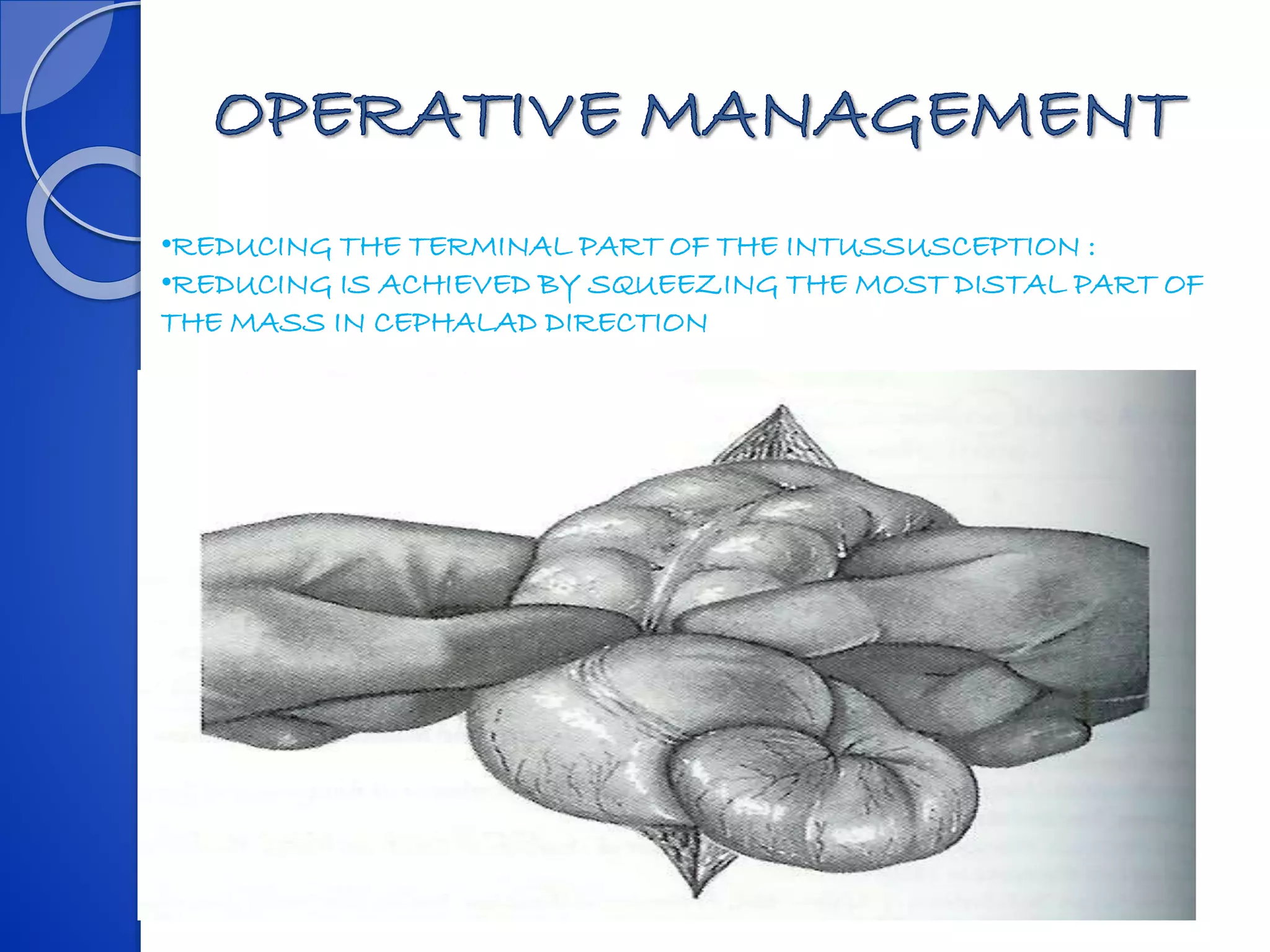 •REDUCING THE TERMINAL PART OF THE INTUSSUSCEPTION :
•REDUCING IS ACHIEVED BY SQUEEZING THE MOST DISTAL PART OF
THE MASS IN CEPHALAD DIRECTION
 