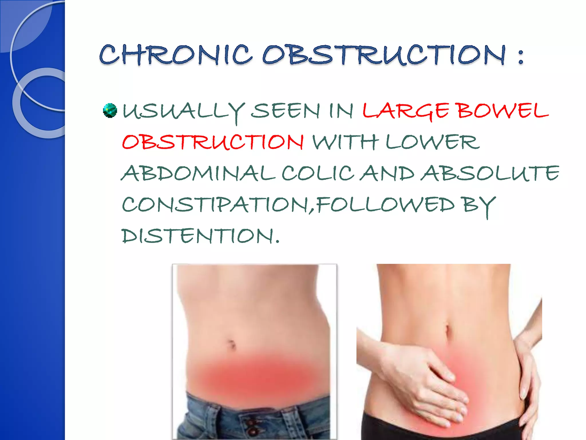 USUALLY SEEN IN LARGE BOWEL
OBSTRUCTION WITH LOWER
ABDOMINAL COLIC AND ABSOLUTE
CONSTIPATION,FOLLOWED BY
DISTENTION.
 
