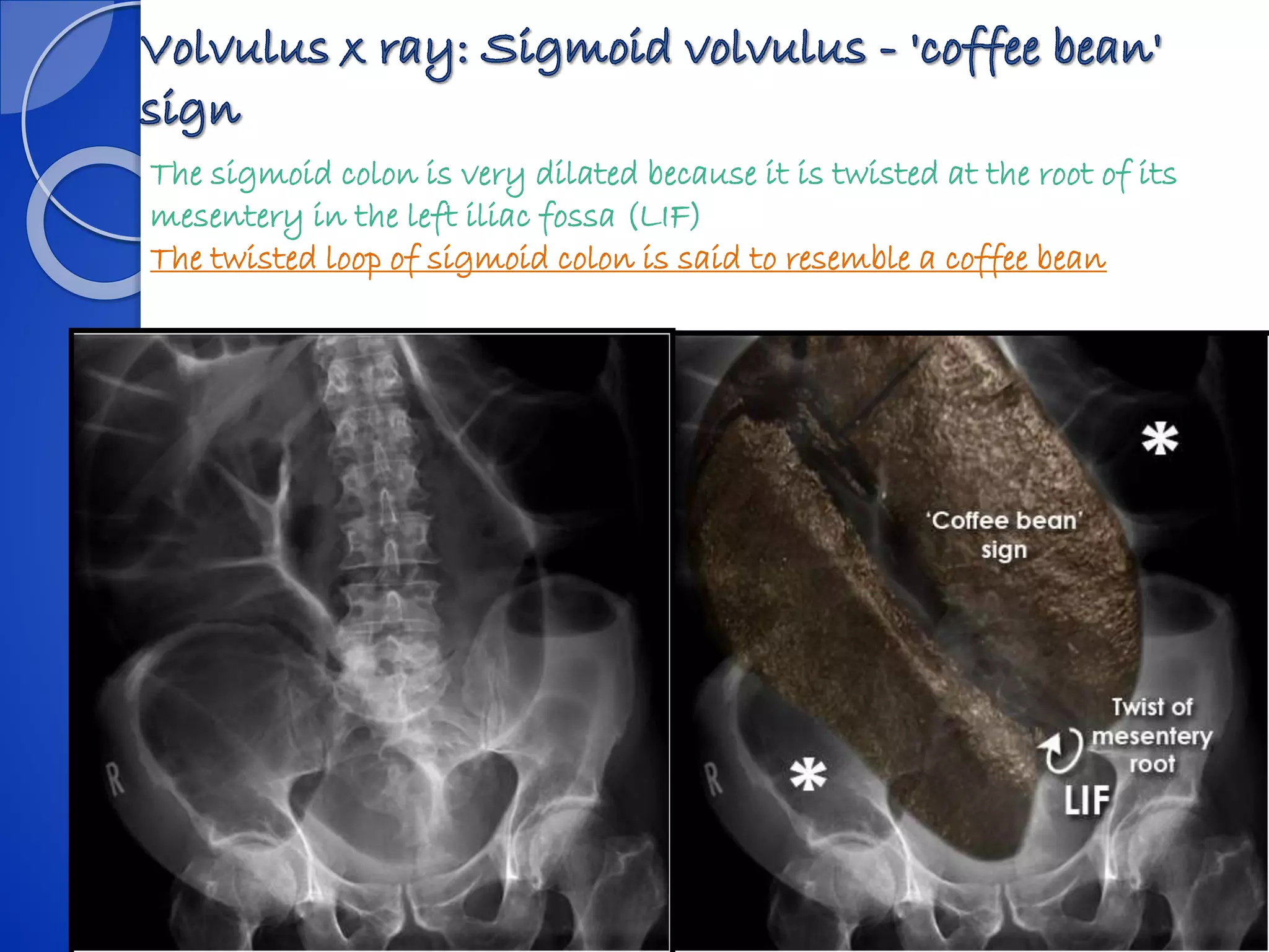 The sigmoid colon is very dilated because it is twisted at the root of its
mesentery in the left iliac fossa (LIF)
The twisted loop of sigmoid colon is said to resemble a coffee bean
 