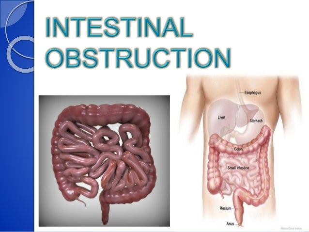 intestinal obstruction intestinal obstruction, Skeleton