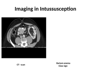 Summary of bowel obstruction.in surgery.145pptx | PPTX