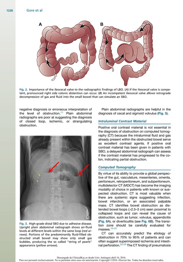Bowel obstruction - Radiology Clinics 2015 | PDF
