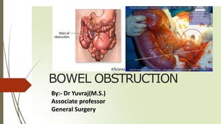 BOWEL OBSTRUCTION
By:- Dr Yuvraj(M.S.)
Associate professor
General Surgery
 