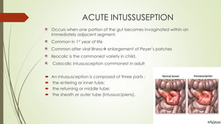 ACUTE INTUSSUSEPTION
Occurs when one portion of the gut becomes invaginated within an
immediately adjacent segment.
Common in 1st year of life
Common after viral illness enlargement of Peyer’s patches
Ileocolic is the commonest variety in child.
Colocolic intussusception commonest in adult
 An intussusception is composed of three parts :
 the entering or inner tube;
 the returning or middle tube;
 the sheath or outer tube (intussuscipiens).
 