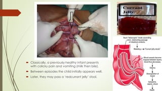  Classically, a previously healthy infant presents
with colicky pain and vomiting (milk then bile).
 Between episodes the child initially appears well.
 Later, they may pass a ‘redcurrant jelly’ stool.
 