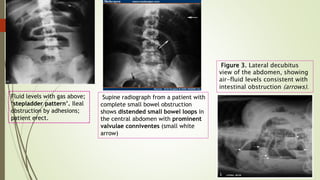 Fluid levels with gas above;
‘stepladder pattern’. Ileal
obstruction by adhesions;
patient erect.
Supine radiograph from a patient with
complete small bowel obstruction
shows distended small bowel loops in
the central abdomen with prominent
valvulae conniventes (small white
arrow)
Figure 3. Lateral decubitus
view of the abdomen, showing
air-fluid levels consistent with
intestinal obstruction (arrows).
 