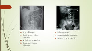  In small bowel
 Central 3cm thick
diameter
 Vulvulae coniventae
 Ileum may occur
tubeless
 In large bowel
 Peripheral diameter 6cm
 Presence of haustration
 