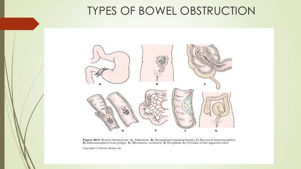 Bowel obstruction