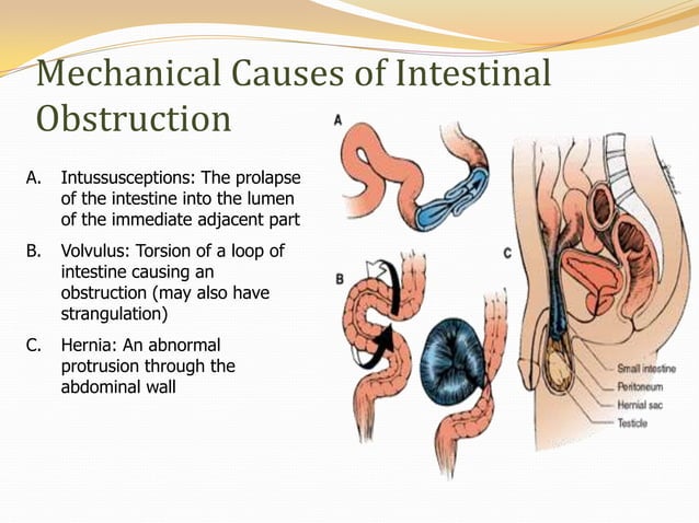 View of Bowel obstruction colorectal ca | PPTX | Digestive Disorders | Diseases ...