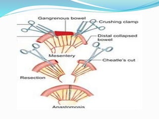 Bowel resection and anastomosis | PPTX