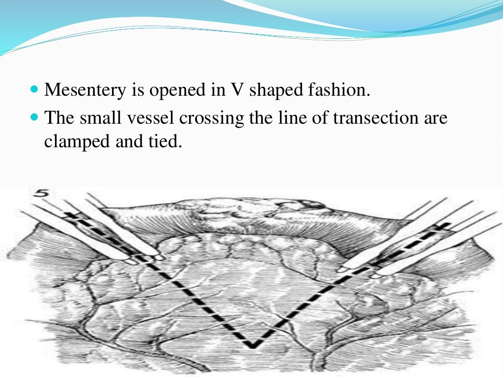 Bowel resection and anastomosis
