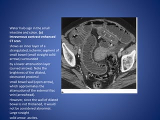 bowel thickening.pptx