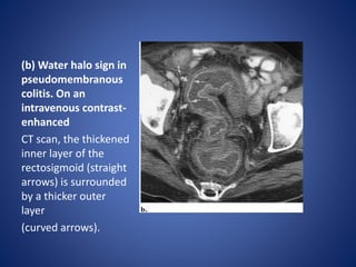 bowel thickening.pptx