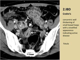 Bowel wall thickening at ct | PPTX