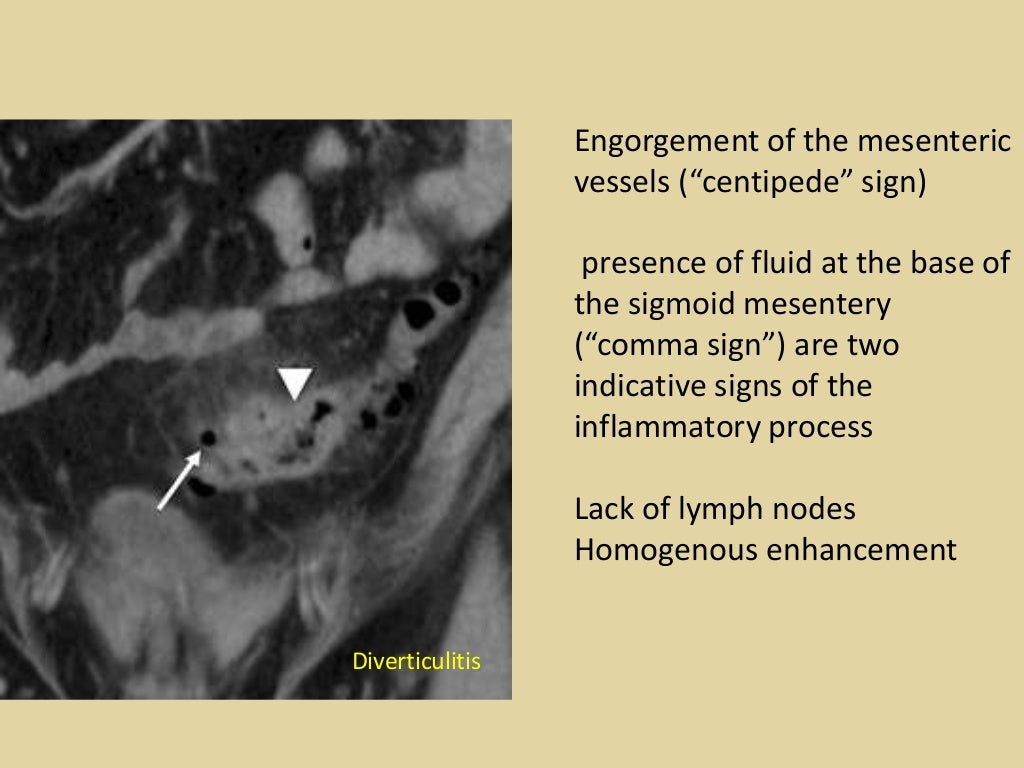 Bowel wall thickening at ct