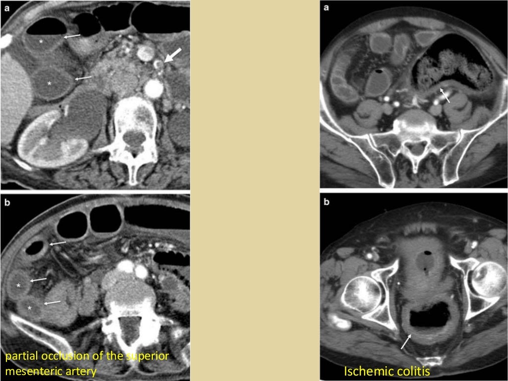 Bowel Wall Thickening At Ct