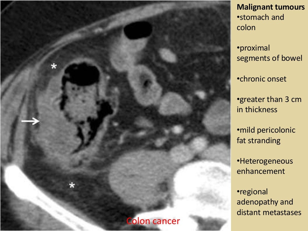 Bowel wall thickening at ct