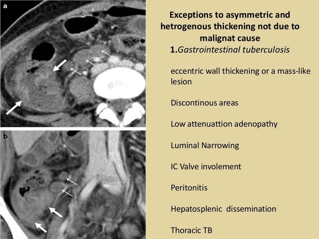 Bowel wall thickening at ct
